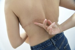 En Andalousie, la détresse de femmes atteintes de cancer du sein, 'oubliées' du système de santé